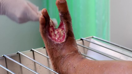cleaning infected wound on foot 