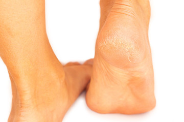 Closeup of horny skin on the heel of a woman's foot on a white background 