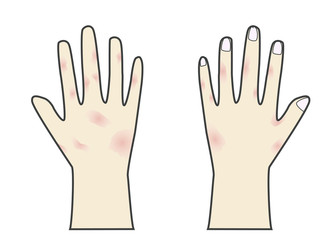 Obraz premium 手荒れ