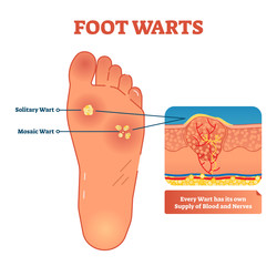 Foot warts vector illustration. Medical scheme with solitary and mosaic warts. Close-up cross section with wart and its own supply of blood and nerves. - obrazy, fototapety, plakaty