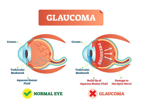 Vector illustration of glaucoma illness. Cross section comparement with normal and damaged eye. Scheme with cornea, trabecular meshwork and aqueous humor fluid.
