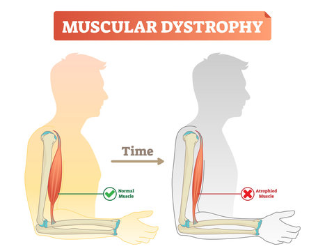 Vector Illustration About Muscular Dystrophy. Compared Normal Muscle And Atrophied Muscle. Medical Scheme How Time Affects Health - Healthy And Weak Human.