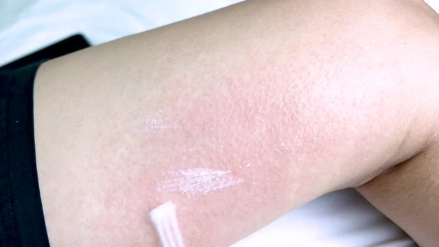Allergic rash dermatitis eczema on skin.