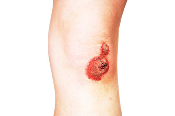 Fototapeta premium Bruised wound injury on knee and Bruised skin.