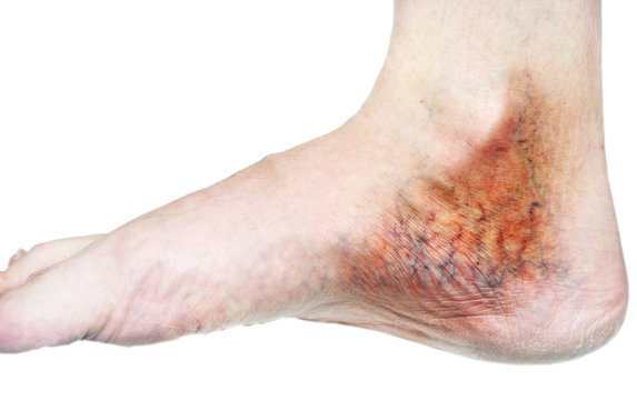 human leg with blocked veins, thrombosis, phlebitis, and standing on a white background, with depth of field Photo