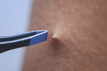  metal cosmetic tool tweezers pull hair from the human skin
