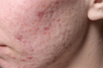 Young woman with acne on her face, closeup