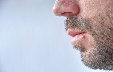 Fototapeta premium Young bird man with big yellow pimple on the lower lip
