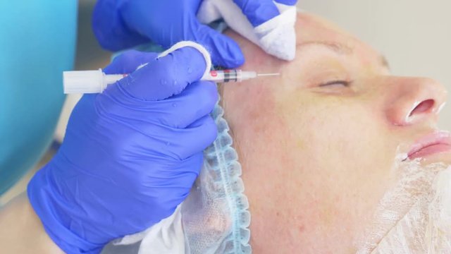 procedure for cleaning the face in the doctor's office of a dermatologist. 4k, close-up, slow-motion . Squeezing the infected pustulous acne to inoculation