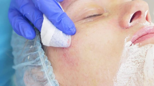 procedure for cleaning the face in the doctor's office of a dermatologist. 4k, close-up, slow-motion . Squeezing the infected pustulous acne to inoculation