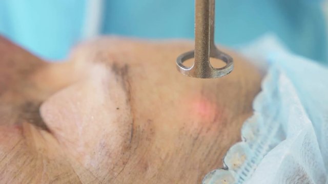 Carbon facial treatment. Laser pulses cleanse the skin of the face. Hardware cosmetology treatment. carbon peeling. close-up. super Slow motion