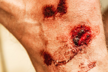 Flesh wounds with blood on male foot closeup