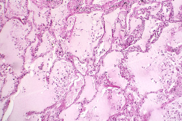 Histopathology of acute pulmonary edema, light micrograph showing accumulation of fluid inside alveoli