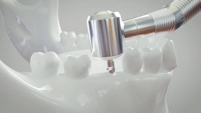 V02 - Zahn Implantat Operation - Arbeitsschritte - detailreich