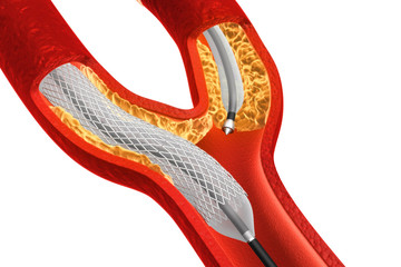Balloon Expandable Stent. Anatomical concept