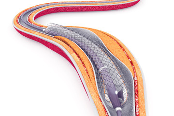 Balloon Expandable Stent. Anatomical concept