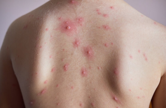 Little girl with a chickenpox on her back