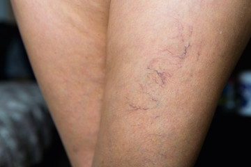 Fototapeta premium Na kobiecej nodze widoczne są brzydkie małe żyłki.