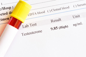 Abnormal high testosterone hormone test result with blood sample tube