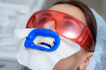 Preparing the oral cavity for whitening with an ultraviolet lamp. Close-up