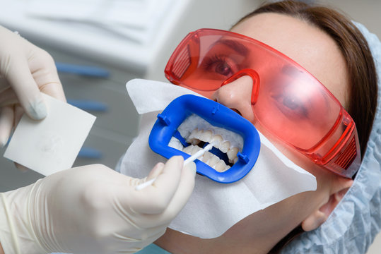 Preparing the oral cavity for whitening with an ultraviolet lamp. Close-up