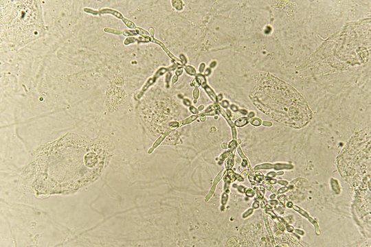 Pseudohyphae and budding yeast cells in patient urine 