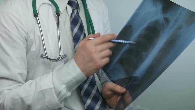 This video features a close-up shot of a male doctor standing at his office, he is holding and analyzing x-ray scan of patient`s lungs. 