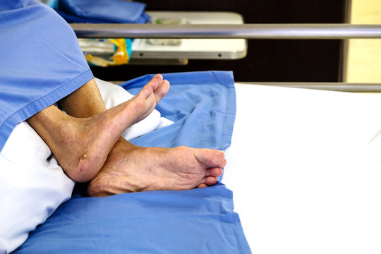 Feet of Paralysis Patients on the Hospital Bed.