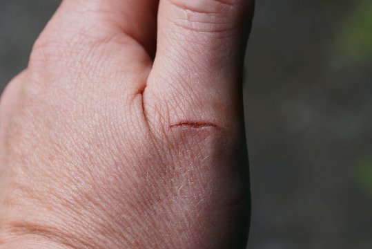 a cut on the finger of a man
