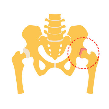 Fragment of the structure of the human skeleton. Pelvic girdle and hips. Coxarthrosis. Destruction of connective cartilaginous tissue. Silhouette. Sign.  Flat design