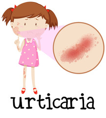 Young girl with urticaria