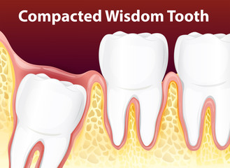 Compacted Wisdom Diagram Tooth