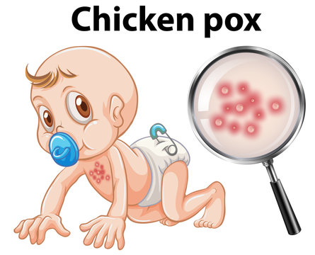 A Baby with Chicken Pox