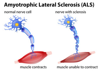 Amyotrophic lateral sclerosis concept - obrazy, fototapety, plakaty