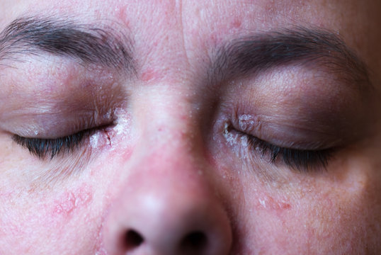 Psoriasis