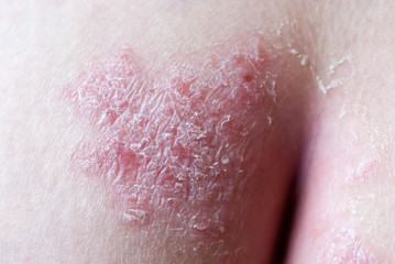 Psoriasis