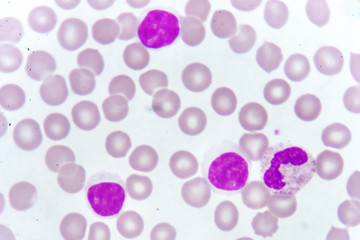 White blood cells in blood smear, analyze by microscope
