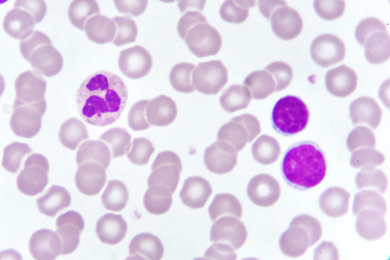 White blood cells in blood smear, analyze by microscope
