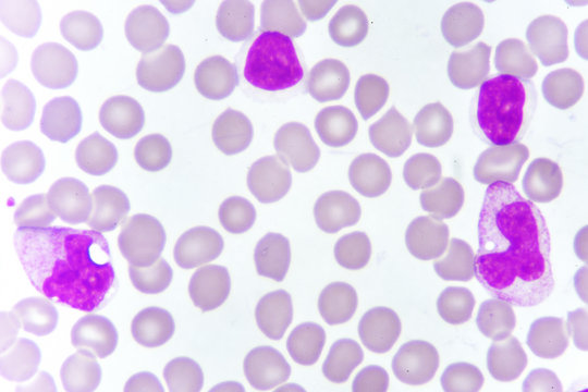 White blood cells in blood smear, analyze by microscope
