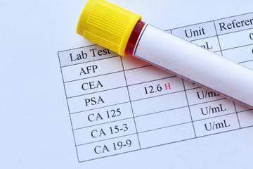 Abnormal high PSA test result with blood sample tube