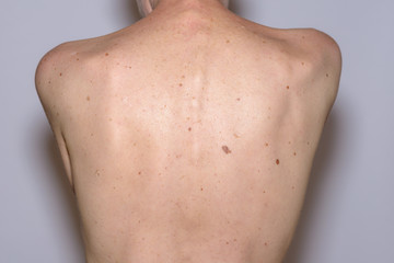 The back of a woman with many liver spots