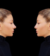 Rhinoplasty.Before and after