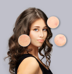 Post-Acne Marks /Treating Acne Scars