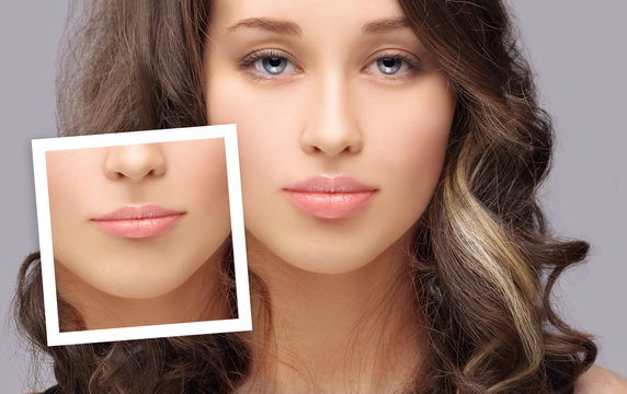 Beauty injections.Concept of rejuvenation.Lip augmentation