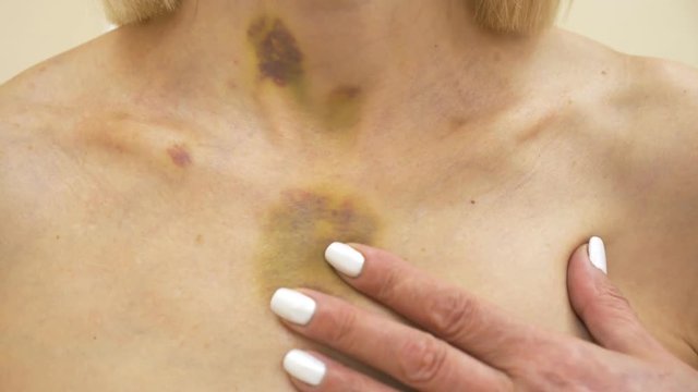 bruises on the neck and chest of a woman. 4k, close-up