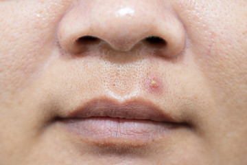 Fototapeta premium Acne inflammation above the lips Women's health concept