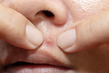 Hands squeezing acne on the lips for the health of women.