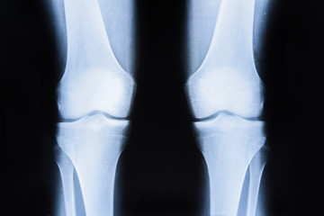 X-ray of the bones of the leg of the knees