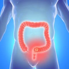 3d illustration of colorectal cancer