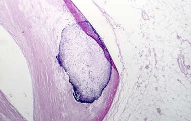 Artery calcification, narrowing of artery, light micrograph, photo under microscope
